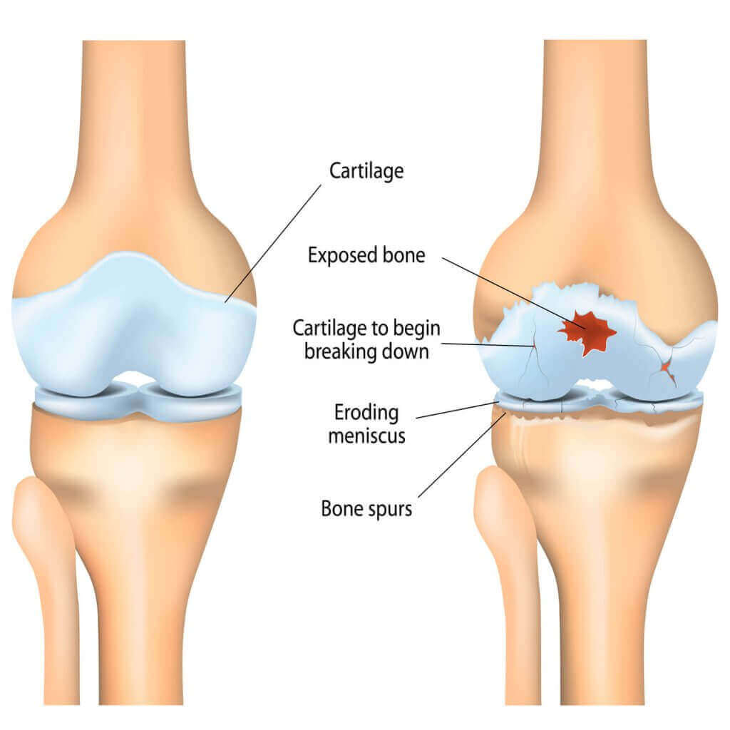 Knorpelaufbau, Arthrose