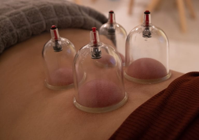 Bei einer Schröpftherapie in der Naturgsund Naturheilpraxis werden vier transparente Saugnäpfe aus Kunststoff auf den nackten Rücken einer Person gesetzt. Die Person liegt, teilweise mit einer grauen Decke bedeckt.